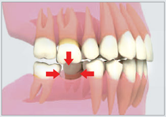 ¿Por qué es tan importante reemplazar una pieza dental perdida?