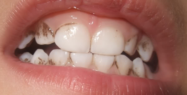 Manchas en los dientes. Causas y tratamientos para hacerlas desaparecer