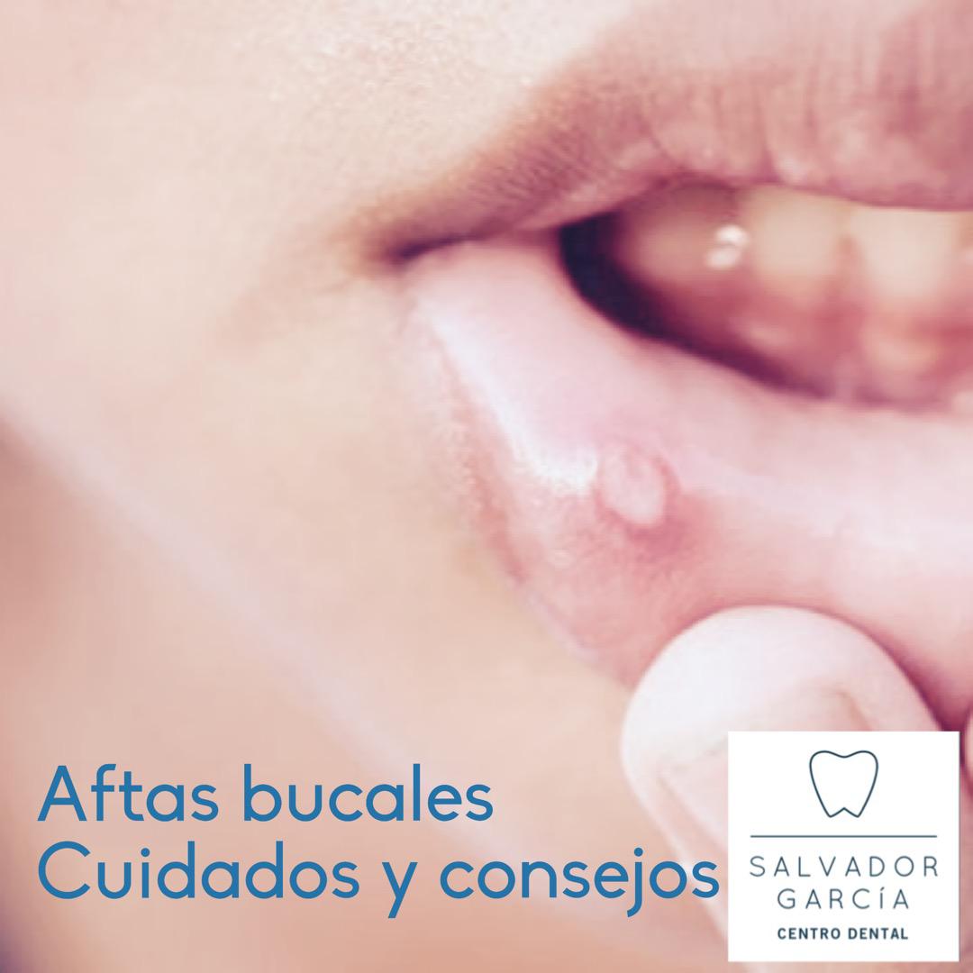 Consejos y cuidados para las aftas bucales (llagas)